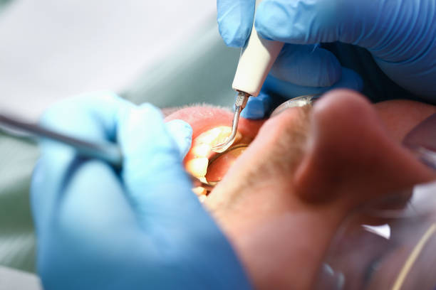 Best Emergency Treatment for Dental Infections or Abscesses in Philipsburg, PA