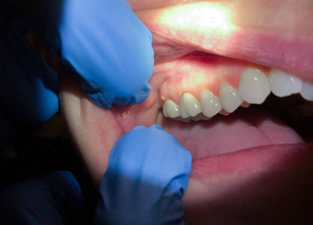 Best Emergency Treatment for Dental Infections or Abscesses in Philipsburg, PA