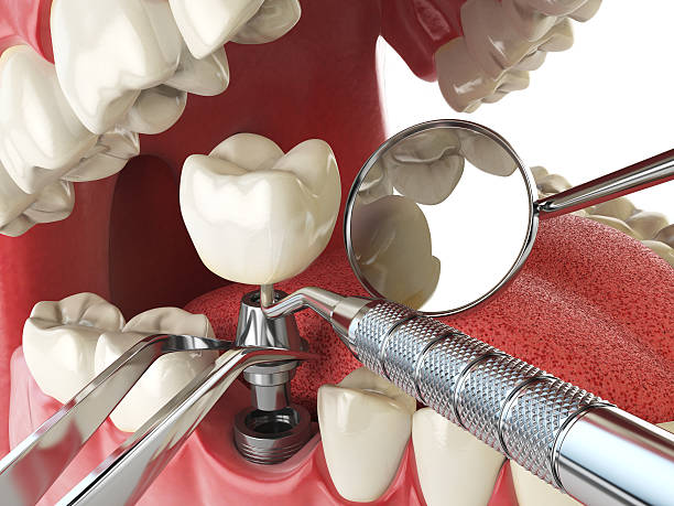 Best Emergency Root Canal Treatment in Philipsburg, PA